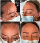 facial-vein-treatment-before-after