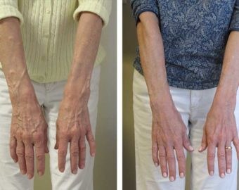 hand vein treatment patient