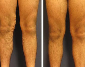 Vein treatment patient