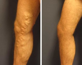 varicose vein patient